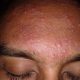 acné-vulgar-en-piel-grasa-granos-pústulas-pàpulas-tratamiento-facial Elche
